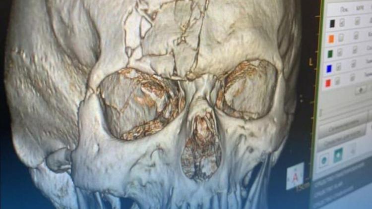 В Ставрополе провели операцию по реконструкции черепа и глазницы