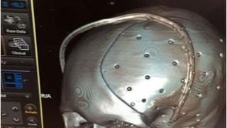 Ставропольские врачи провели уникальную операцию на черепе пациента