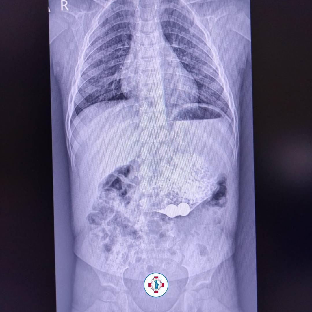 Ставропольские врачи спасли трех проглотивших магнитные шарики детей |  Ставропольская правда