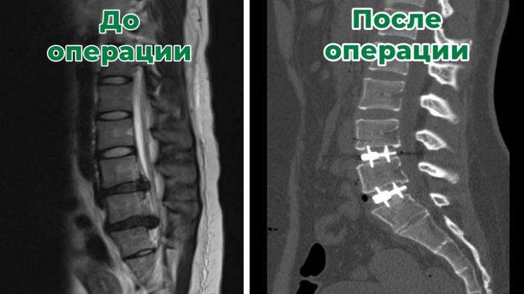 Впервые на Ставрополье нейрохирурги выполнили многоуровневое протезирование