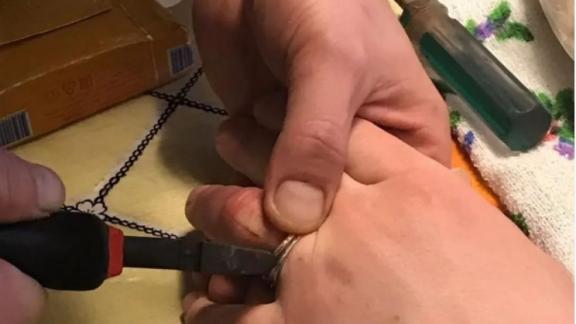Спасатели в Ставрополе помогли девушке снять кольцо с опухшего пальца